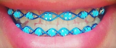 Piercing x aparelhos dentários falsos - modismo perigoso